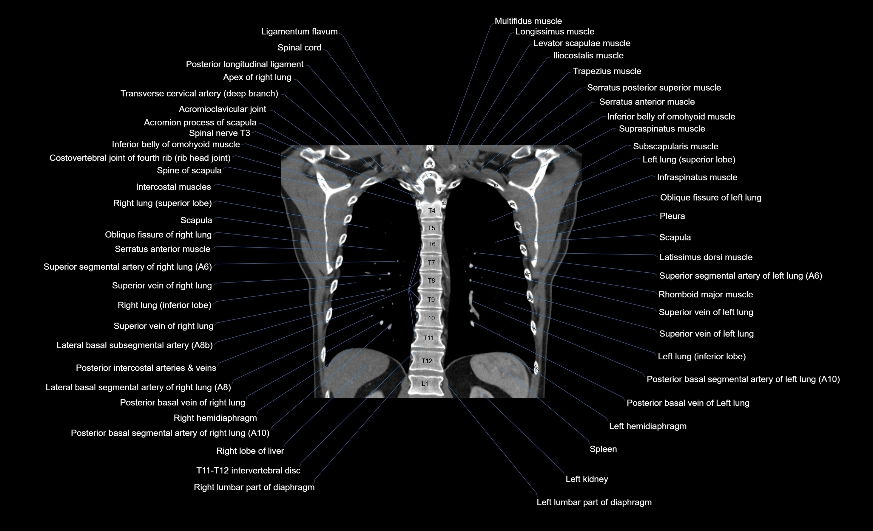 CT chest (thorax) soft tissue window labelled coronal cross sectional anatomy radiology image-00037.webp